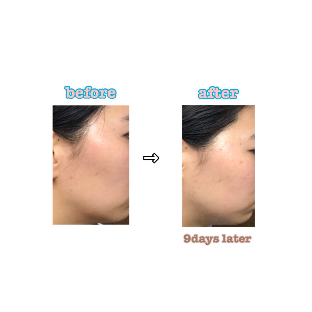 デュオ ザ クレンジングバーム/DUO/クレンジングバームを使ったクチコミ（2枚目）