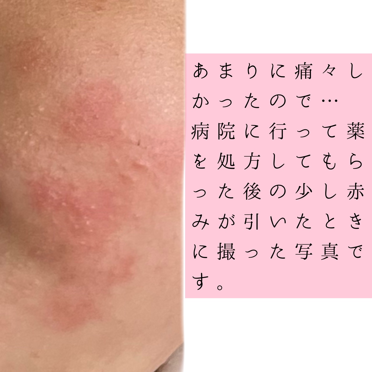 薬用しみ対策 美白化粧水/メラノCC/化粧水を使ったクチコミ（3枚目）