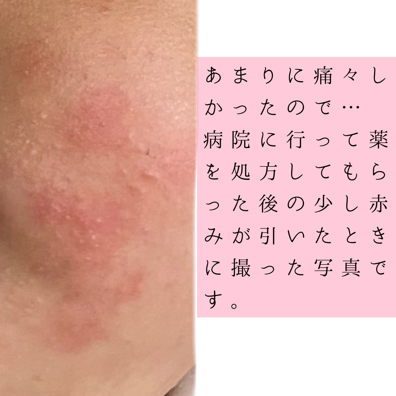 薬用しみ対策 美白化粧水/メラノCC/化粧水を使ったクチコミ(3枚目)