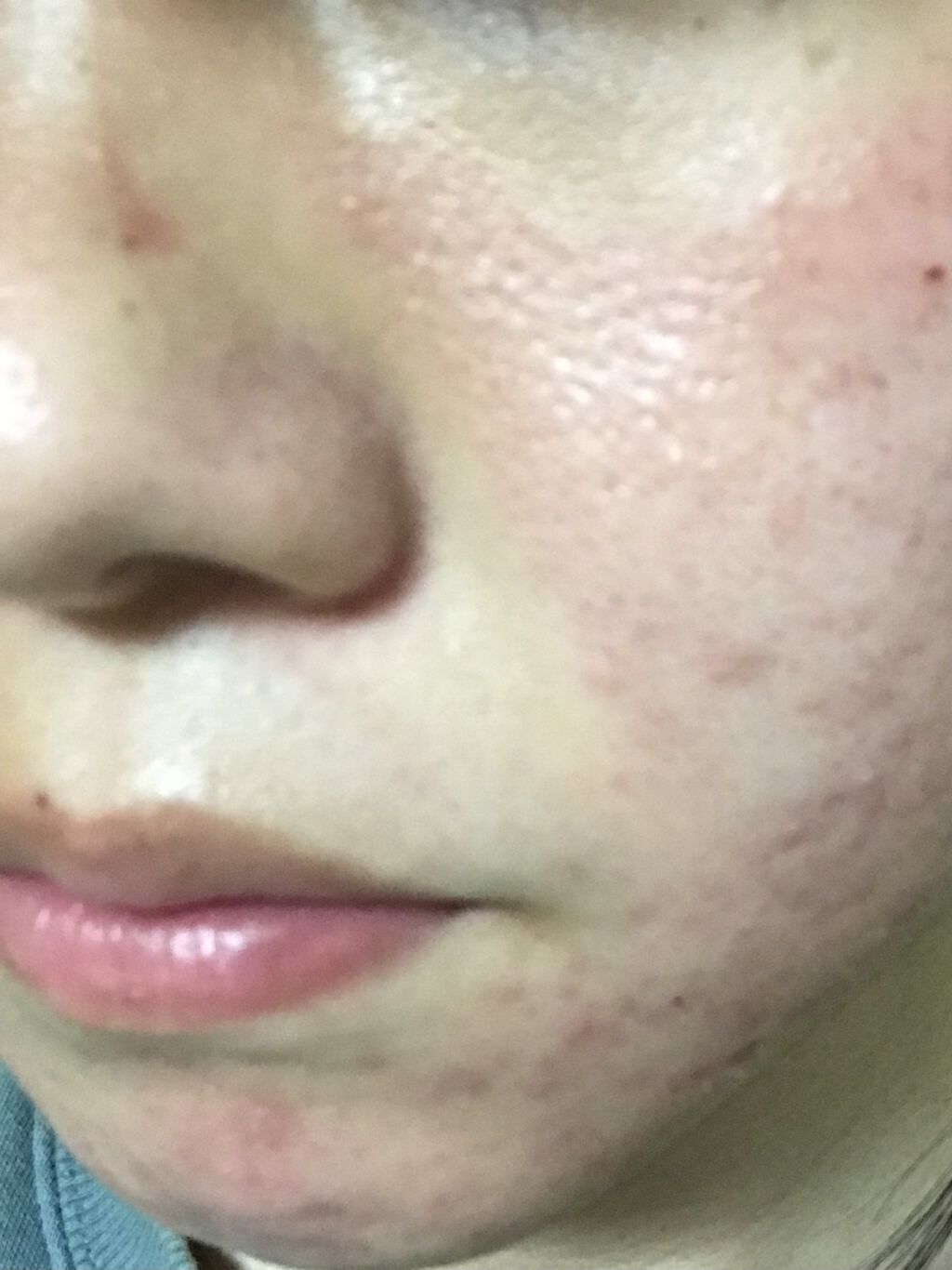 エピデュオゲル/マルホ株式会社/その他を使ったクチコミ（2枚目）