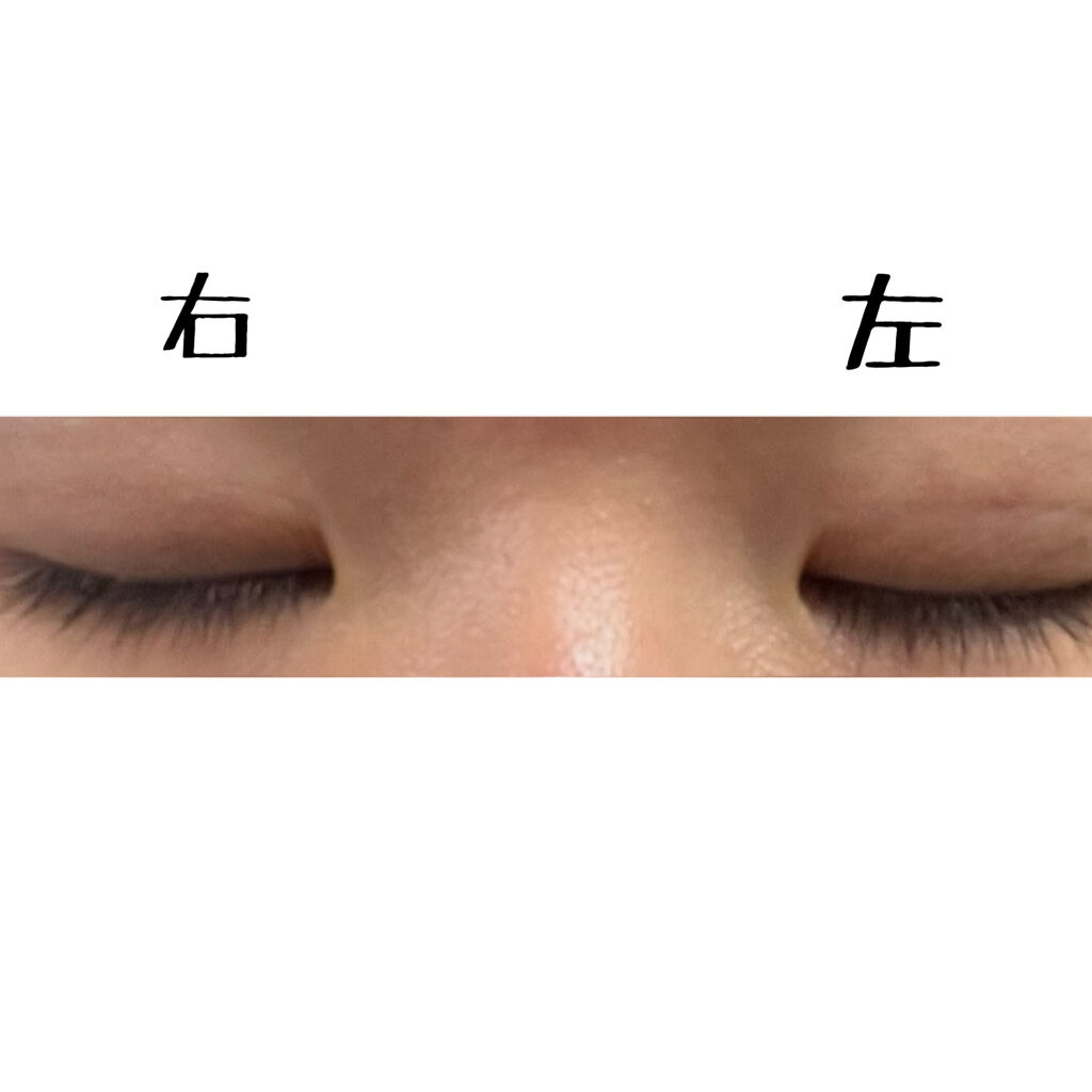 二重整形/その他を使ったクチコミ（2枚目）