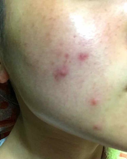 テラ・コートリル 軟膏(医薬品)/ジョンソン・エンド・ジョンソン/その他を使ったクチコミ(1枚目)