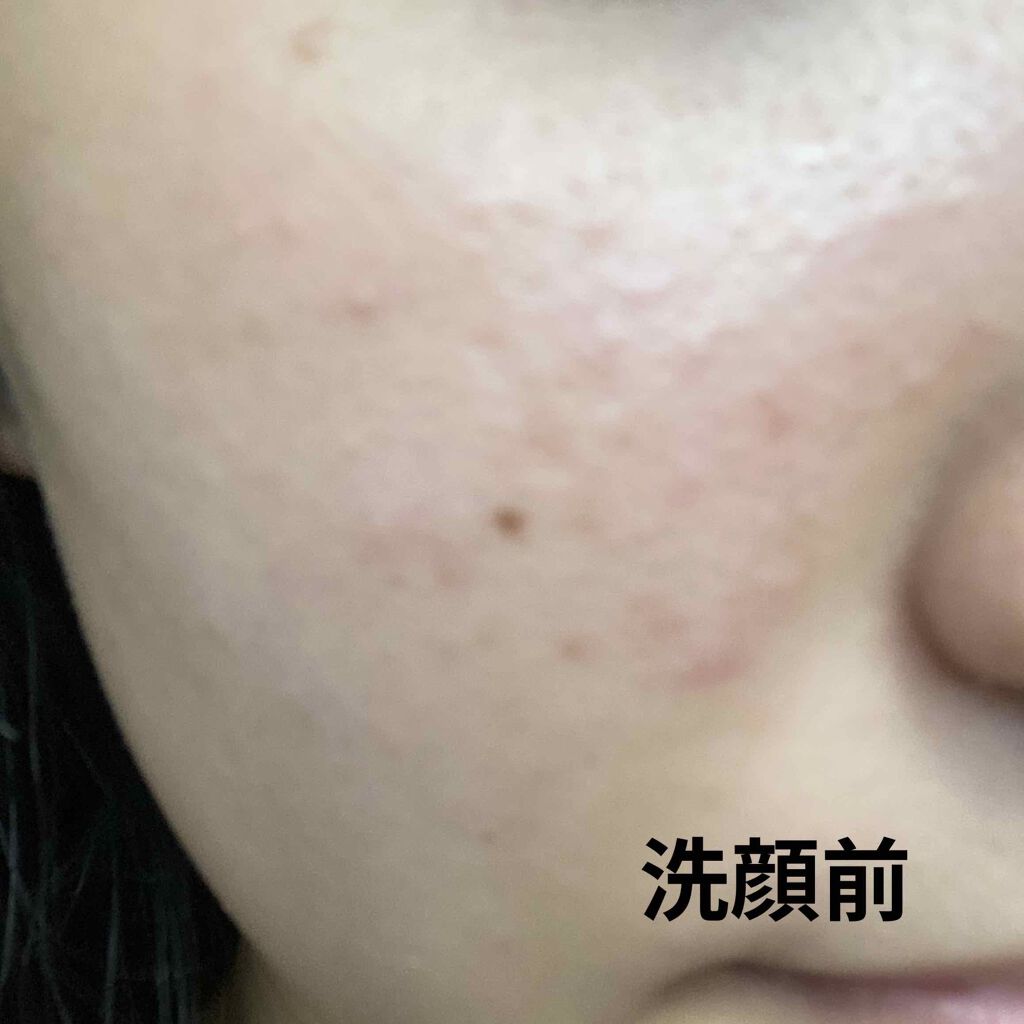 colorful_sounds_j1s on LIPS 「2日目赤みが治まってきて洗顔後はずっと白かったです!!..」(2枚目)