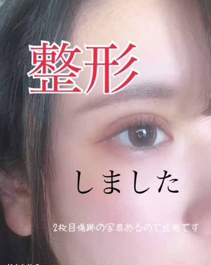 二重整形/その他を使ったクチコミ(1枚目)