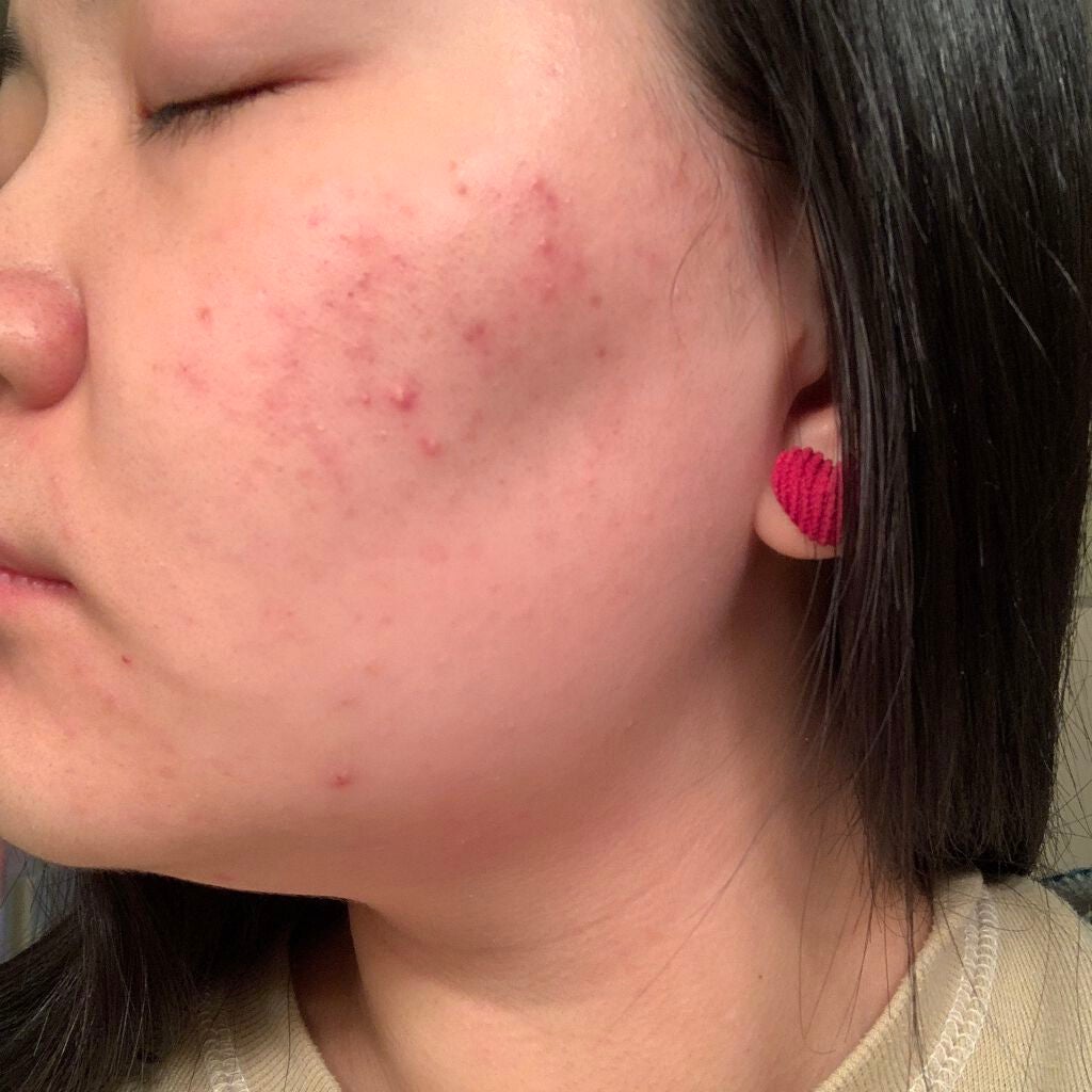 ティーツリーケア ソリューション エッセンシャルマスクEX/MEDIHEAL/シートマスク・パックを使ったクチコミ(2枚目)