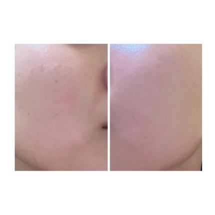 ぽむ on LIPS 「2023.9.13皮膚科に受診 エピデュオとヘパリン処方1枚目..」(5枚目)