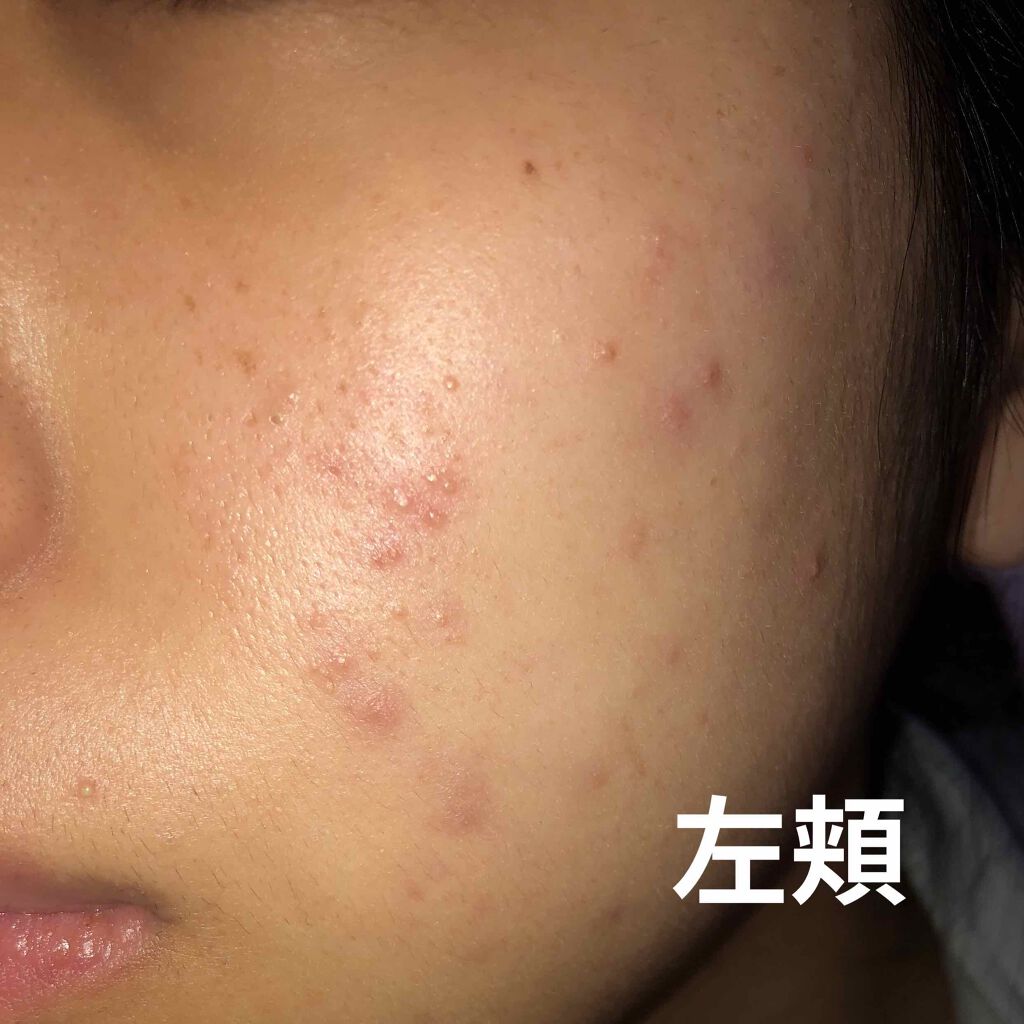 ハトムギ化粧水(ナチュリエ スキンコンディショナー R )/ナチュリエ/化粧水を使ったクチコミ（3枚目）