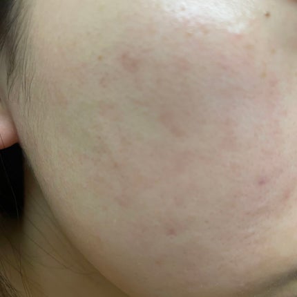 プロCICA クリアスポットパッチ/VT/その他スキンケアを使ったクチコミ(1枚目)