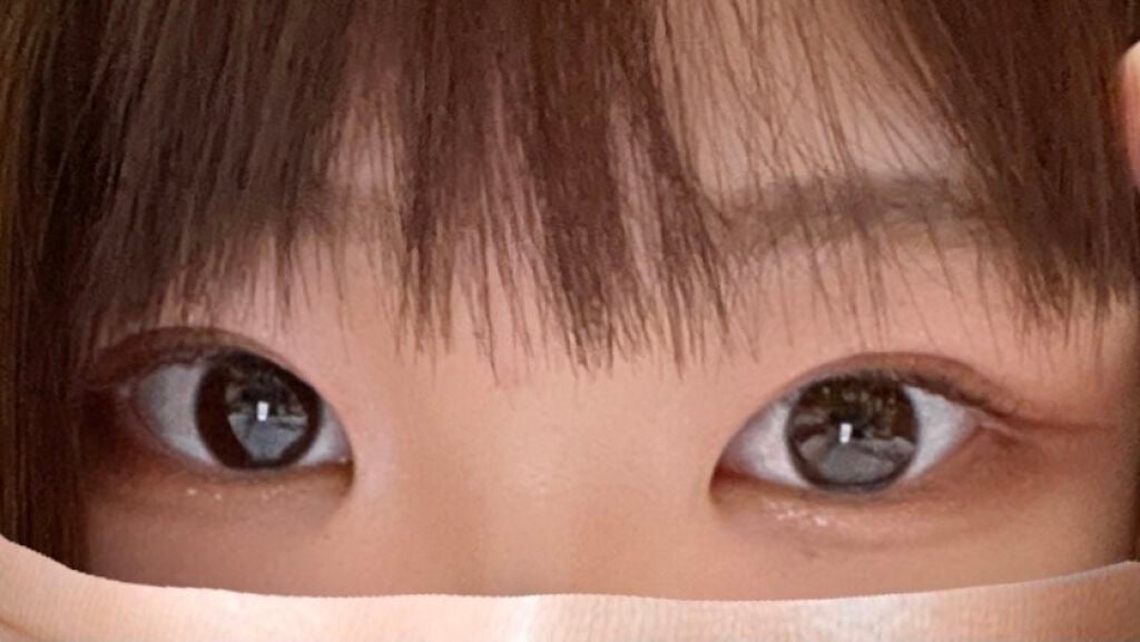 もも on LIPS 「*埋没法記録*これは馴染んでるから幅が狭く見えるんかな施術して..」(1枚目)