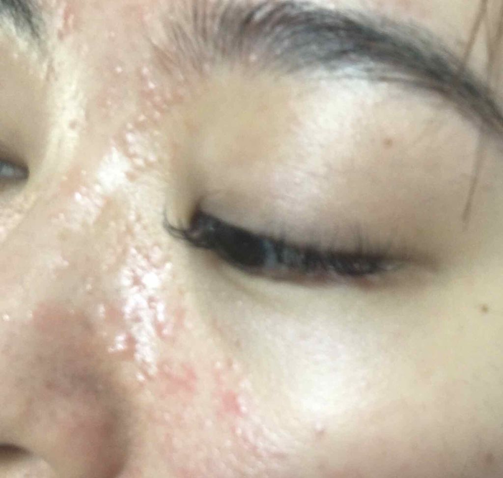 つっつん on LIPS 「ニキビが酷い時に皮膚科で処方された「ベピオゲル」。これが肌に合..」(3枚目)