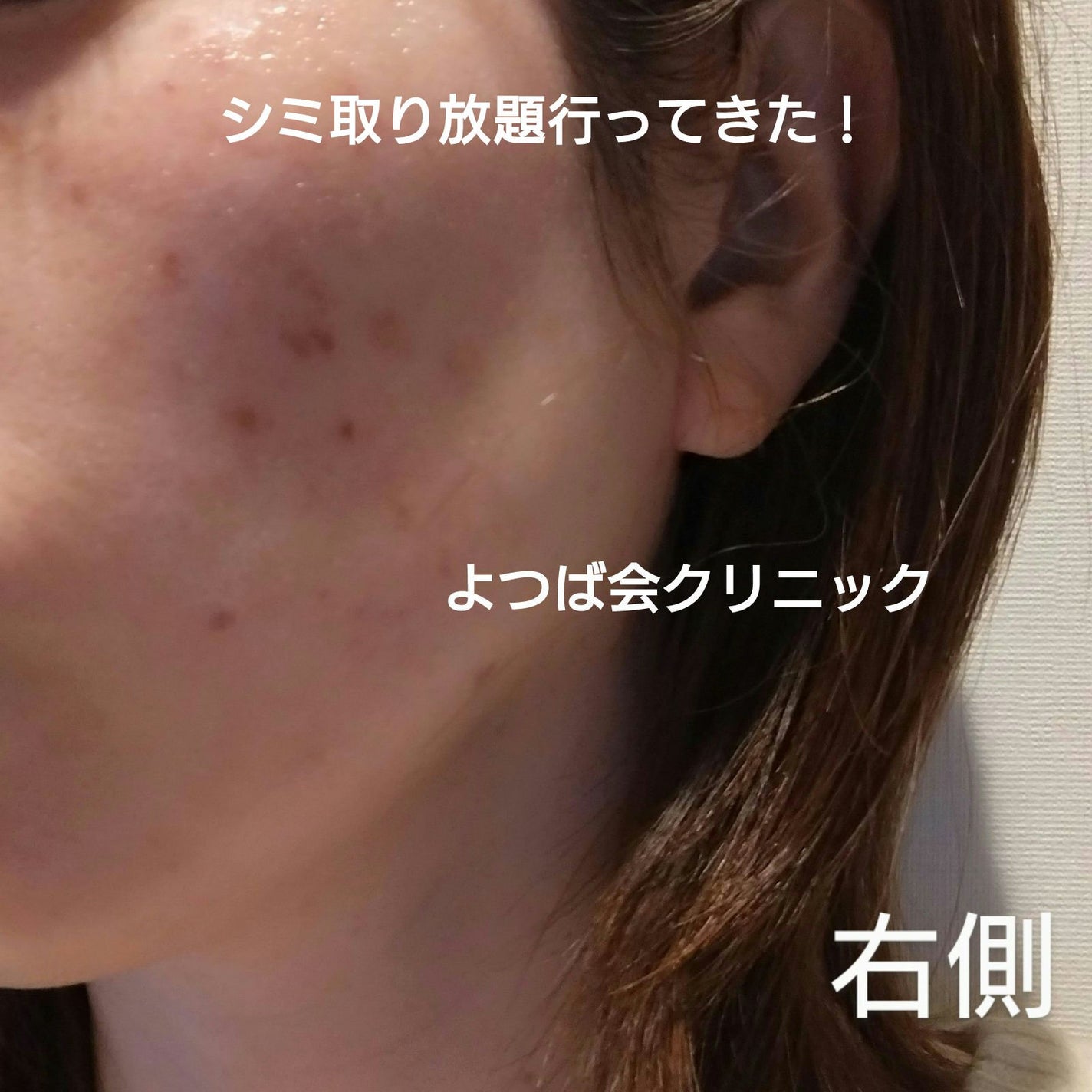 lovecats_sakura on LIPS 「よつば会クリニック京都院行ってきました❤シミ取り放題+美顔で看..」(1枚目)