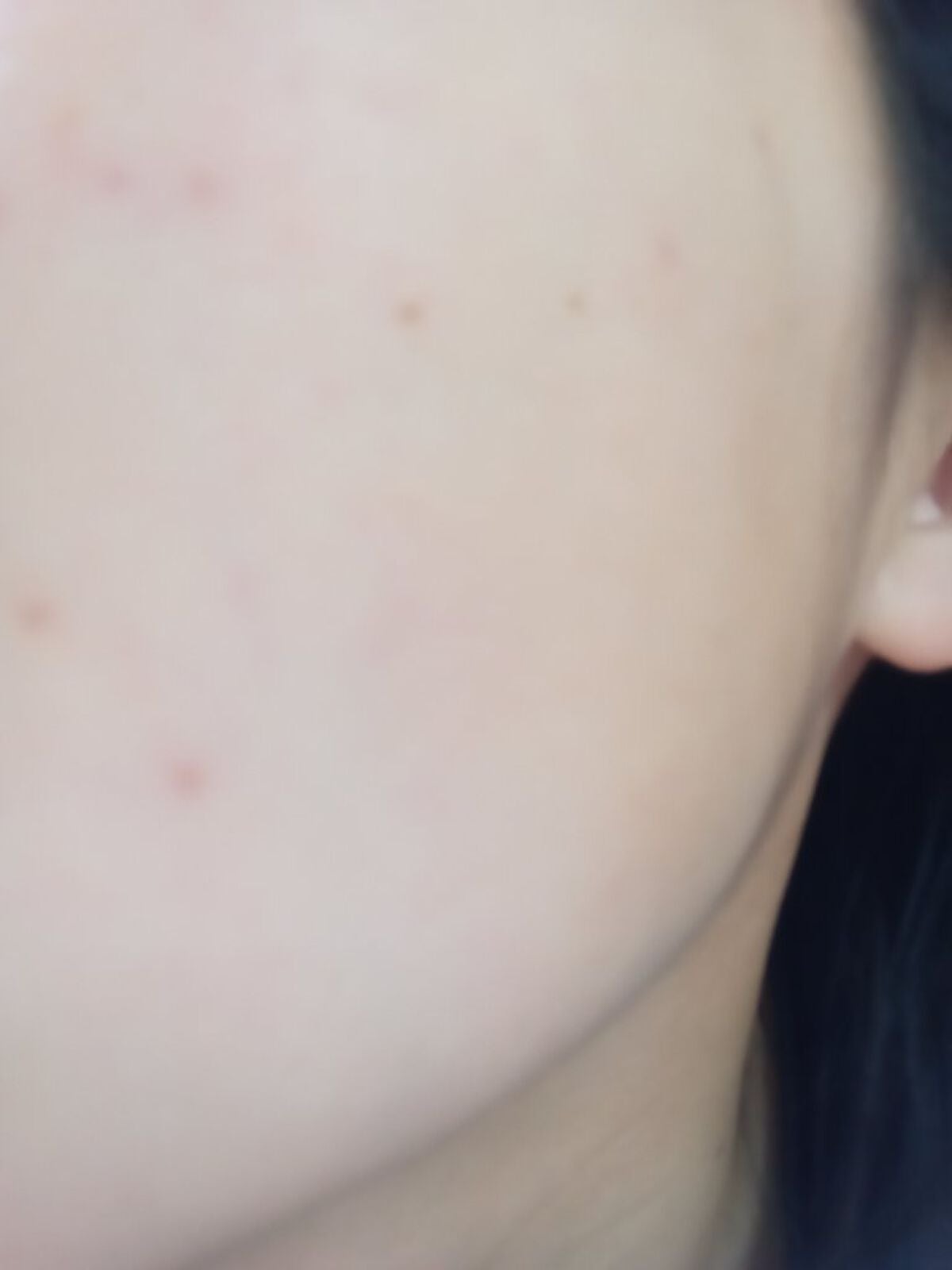 ♡♡♡♡♡ フォロバします! on LIPS 「このニキビってどうやったら綺麗になりますかね??なんかぶつっと..」(4枚目)