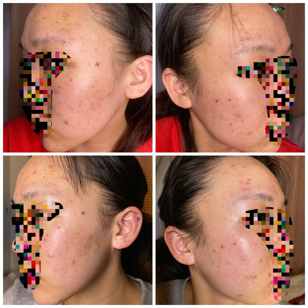 イベリコ豚 on LIPS 「ニキビになり早12年が経過しています。良くなるどころか悪くなる..」(3枚目)