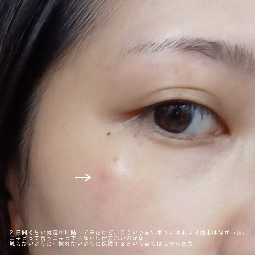 ティーツリーカーミングスポットパッチ/MEDIHEAL/その他スキンケアを使ったクチコミ（3枚目）