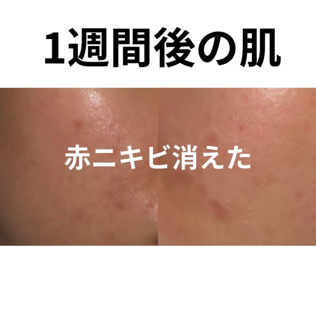 ペアアクネクリームW(医薬品)/ペア/その他を使ったクチコミ(1枚目)