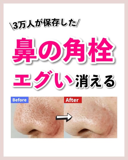 あなたの肌に合ったスキンケア💐コーくん先生 on LIPS 「【知らないとマジで損】エグいほど鼻の角栓が消える方法..あなた..」(1枚目)