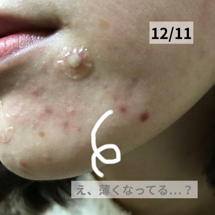 ゼロスポットパッチ/Today’s Cosme/にきびパッチを使ったクチコミ(3枚目)