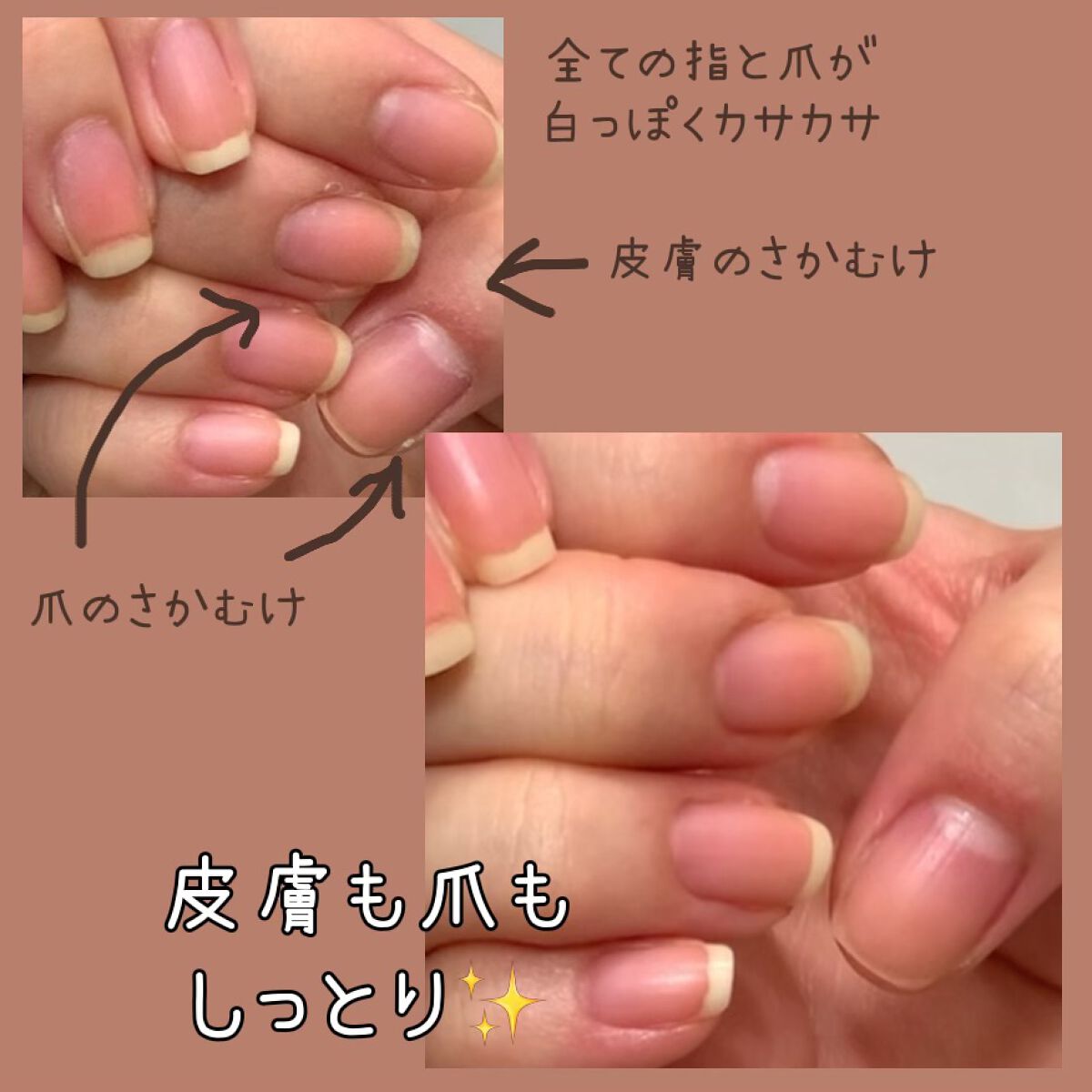 ヒルマイルドクリーム(医薬品)/健栄製薬/その他を使ったクチコミ（2枚目）