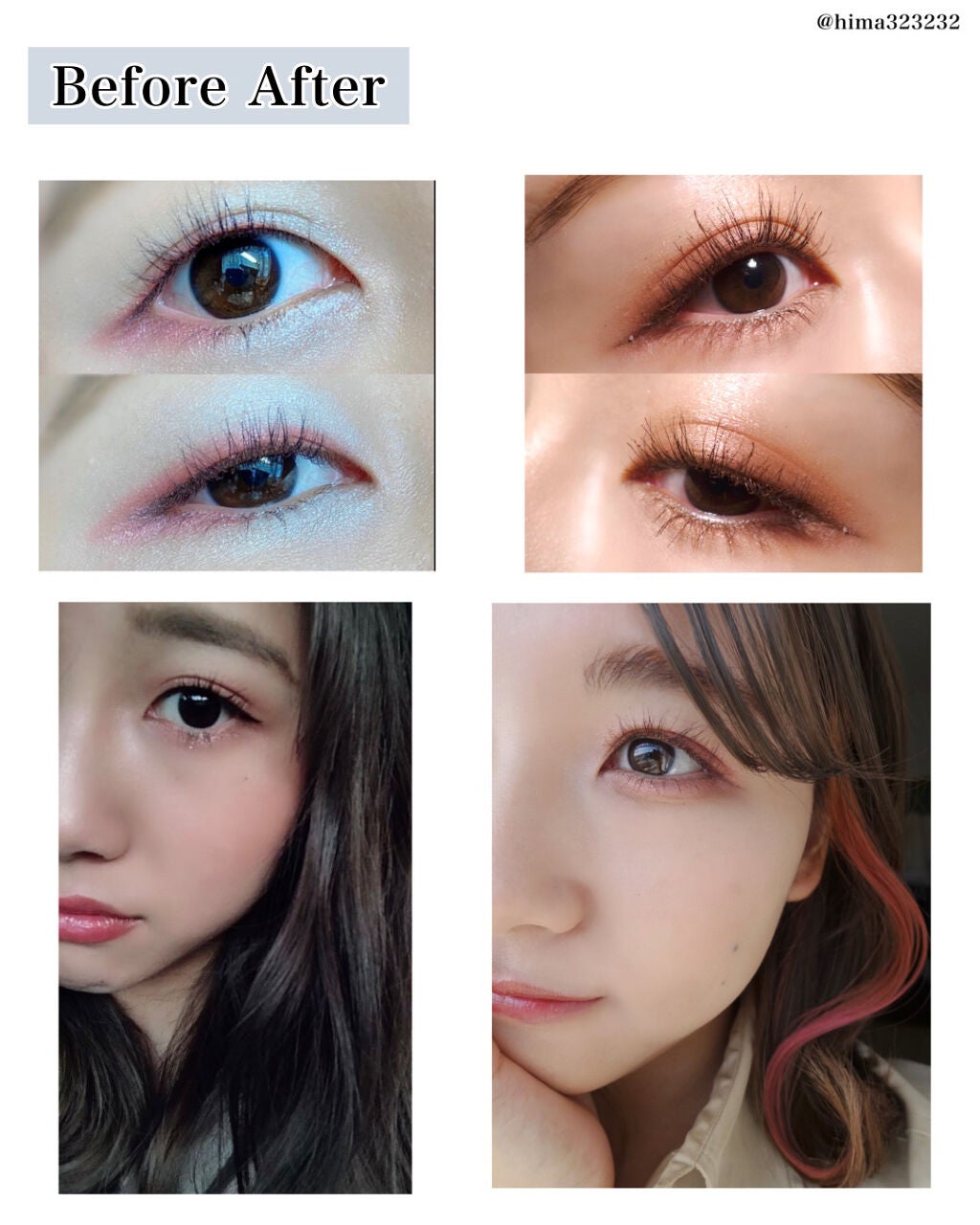 ひまちゃん /垢抜けの参考書 on LIPS 「【整形】〜私が施術した二重埋没について〜本日は!1年半くらい前..」(8枚目)