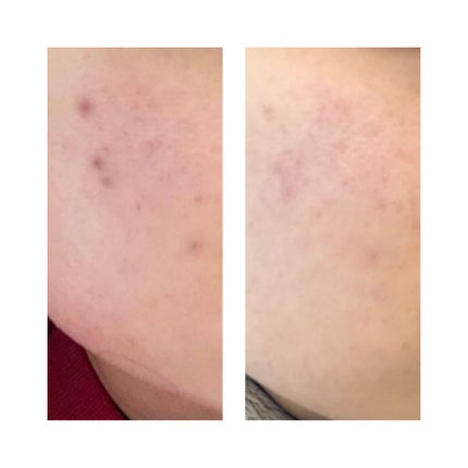 Mone on LIPS 「ちょうどリップスを始めたのが去年の春🌸だったので、当時のお肌と..」(3枚目)