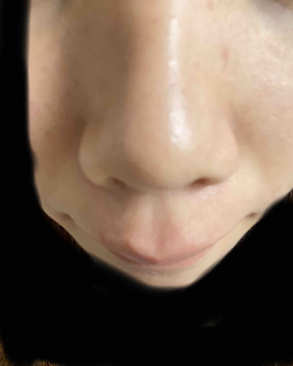 pink_sounds_rrza on LIPS 「べピオゲル14日目すごい綺麗になってる、肌触ってもざらざらしな..」(4枚目)