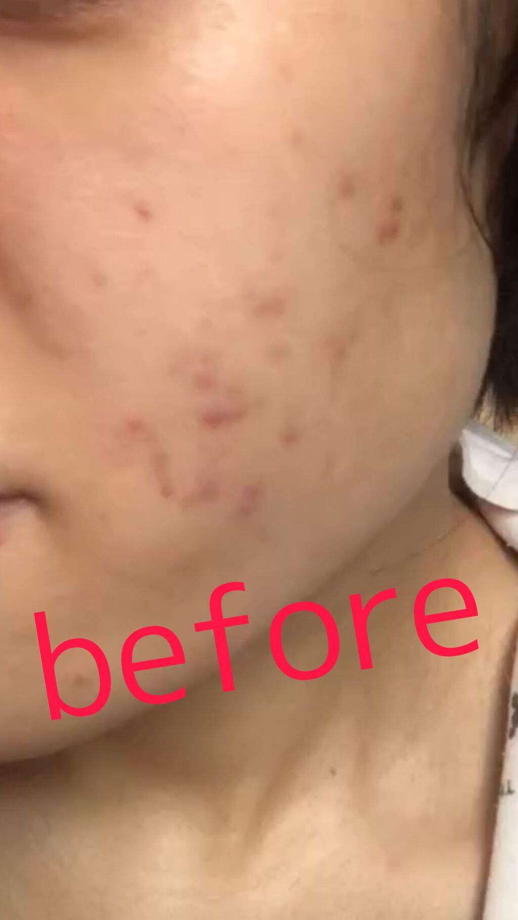 薬用 しみ 集中対策 美容液/メラノCC/美容液を使ったクチコミ(1枚目)