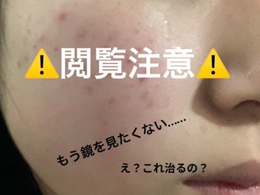 メラノCC 薬用しみ対策 美白化粧水 しっとりタイプのクチコミ「マスク荒れでもう鏡を見たくない…、そんな時期もありました❕
こんにちは、らいあ🐰です❕初投稿な.....」（1枚目）