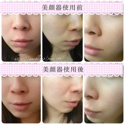 フォトプラス プレステージ for Salon/YA-MAN PROFESSIONAL/美顔器・マッサージを使ったクチコミ(2枚目)
