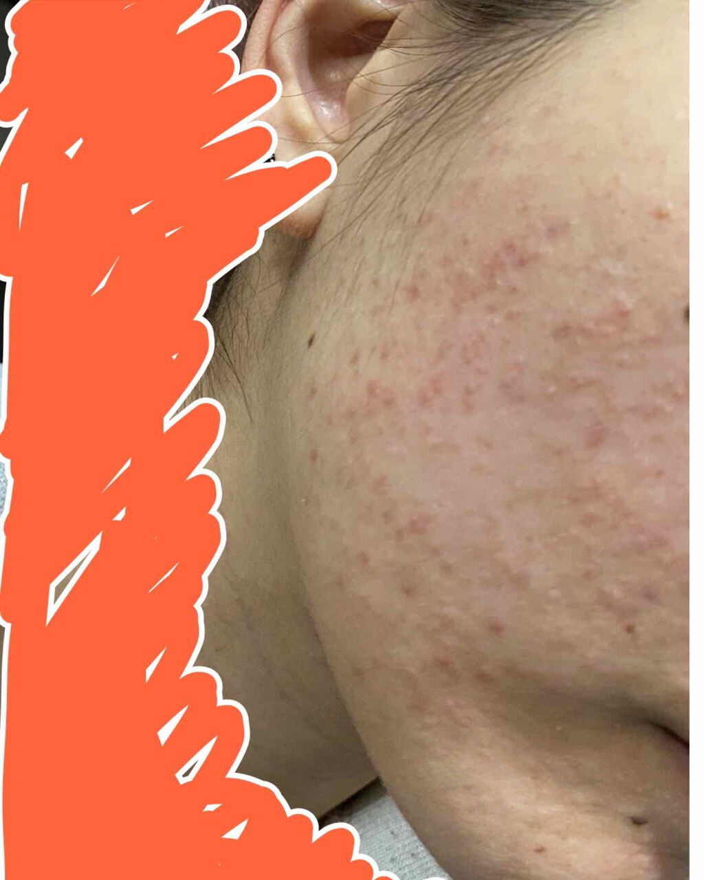 A アクネフォーム/NOV/洗顔フォームを使ったクチコミ（3枚目）