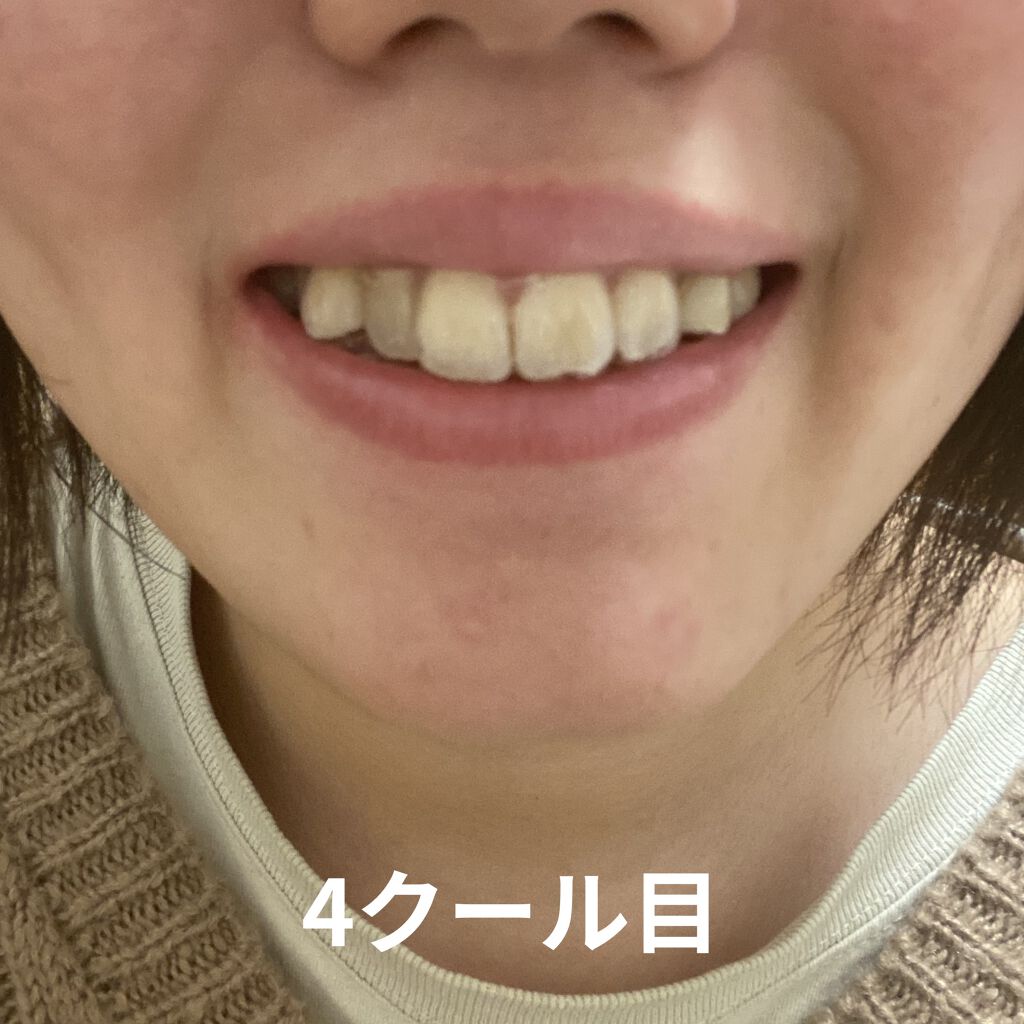 マウスピース矯正/その他を使ったクチコミ（3枚目）