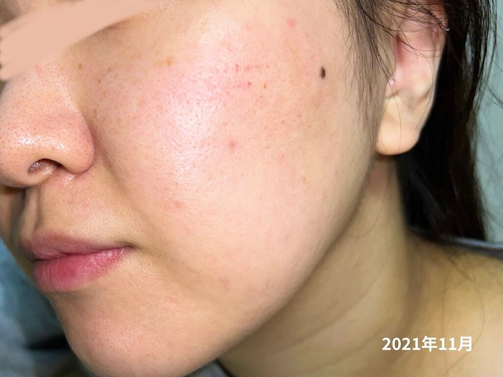 オードムーゲ 薬用ローション(ふきとり化粧水)/オードムーゲ/拭き取り化粧水を使ったクチコミ(3枚目)