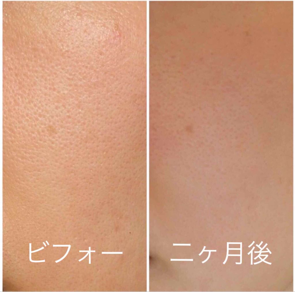 メラノフォーカスV/HAKU/美容液を使ったクチコミ(2枚目)