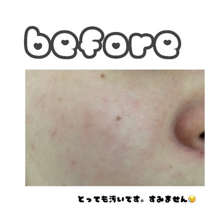 炭酸泡クレンジングパック/piera(ピエラ)/洗い流すパック・マスクを使ったクチコミ(5枚目)