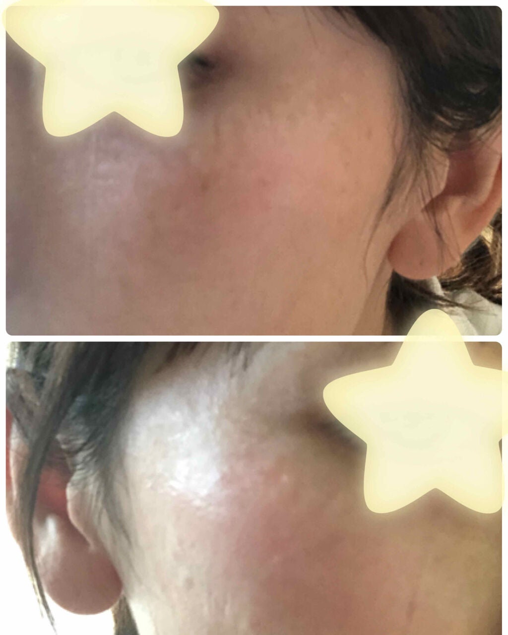 ねこ村 on LIPS 「もうほぼ取れてきて感動的な新しい肌が生まれました😭💕💕感動です..」(2枚目)