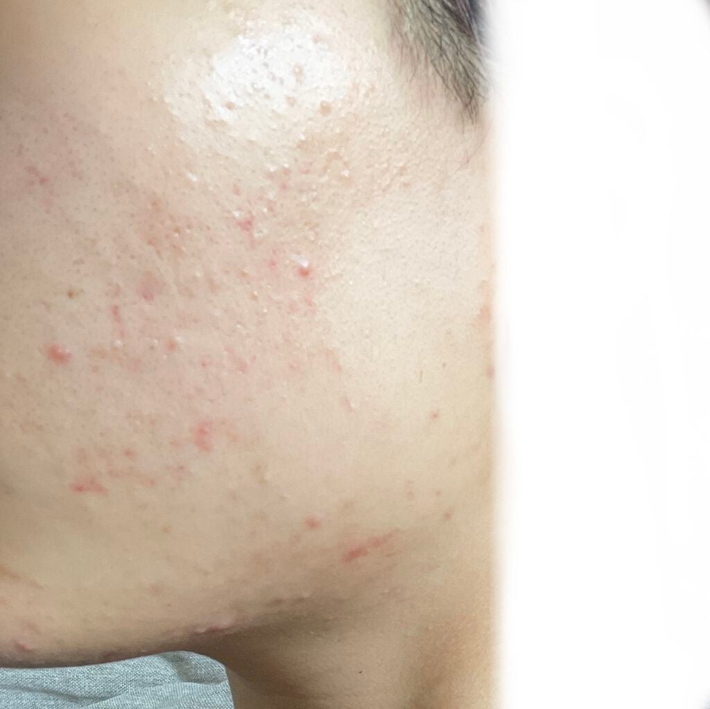 ロゼット洗顔パスタ アクネクリア/ロゼット/洗顔フォームを使ったクチコミ(3枚目)