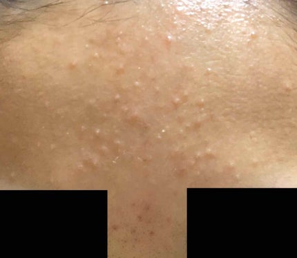 ペアアクネクリームW(医薬品)/ペア/その他を使ったクチコミ(2枚目)