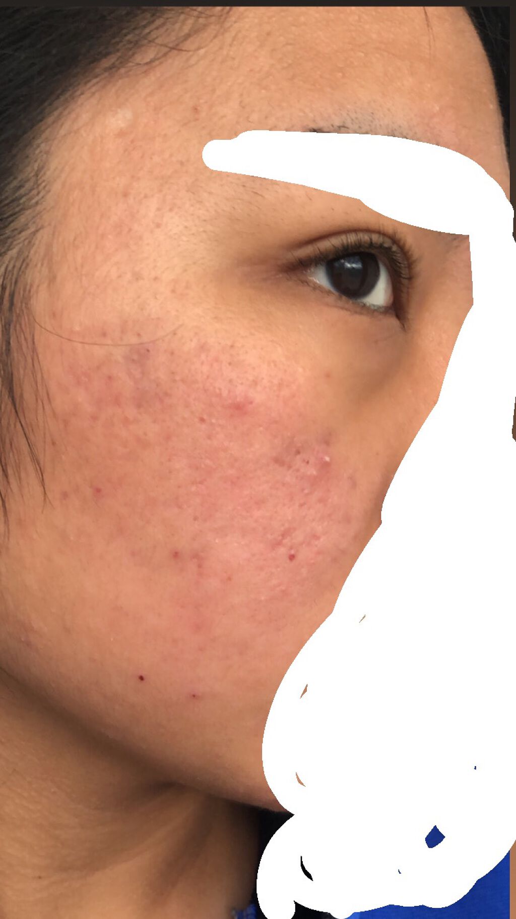 にき子 on LIPS 「【ニキビ治療記録】本当に久しぶりの登校となってしまいすみません..」(2枚目)