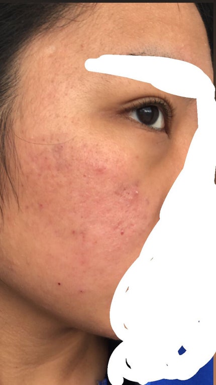 にき子 on LIPS 「【ニキビ治療記録】本当に久しぶりの登校となってしまいすみません..」(2枚目)