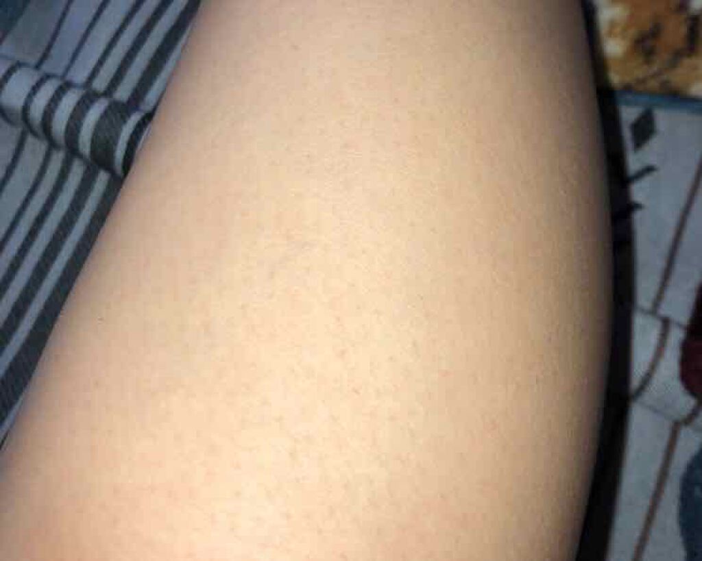 きなこ on LIPS 「カミソリでの脱毛後に!!アロエベラを塗ってみたところ、、毛穴が..」(2枚目)