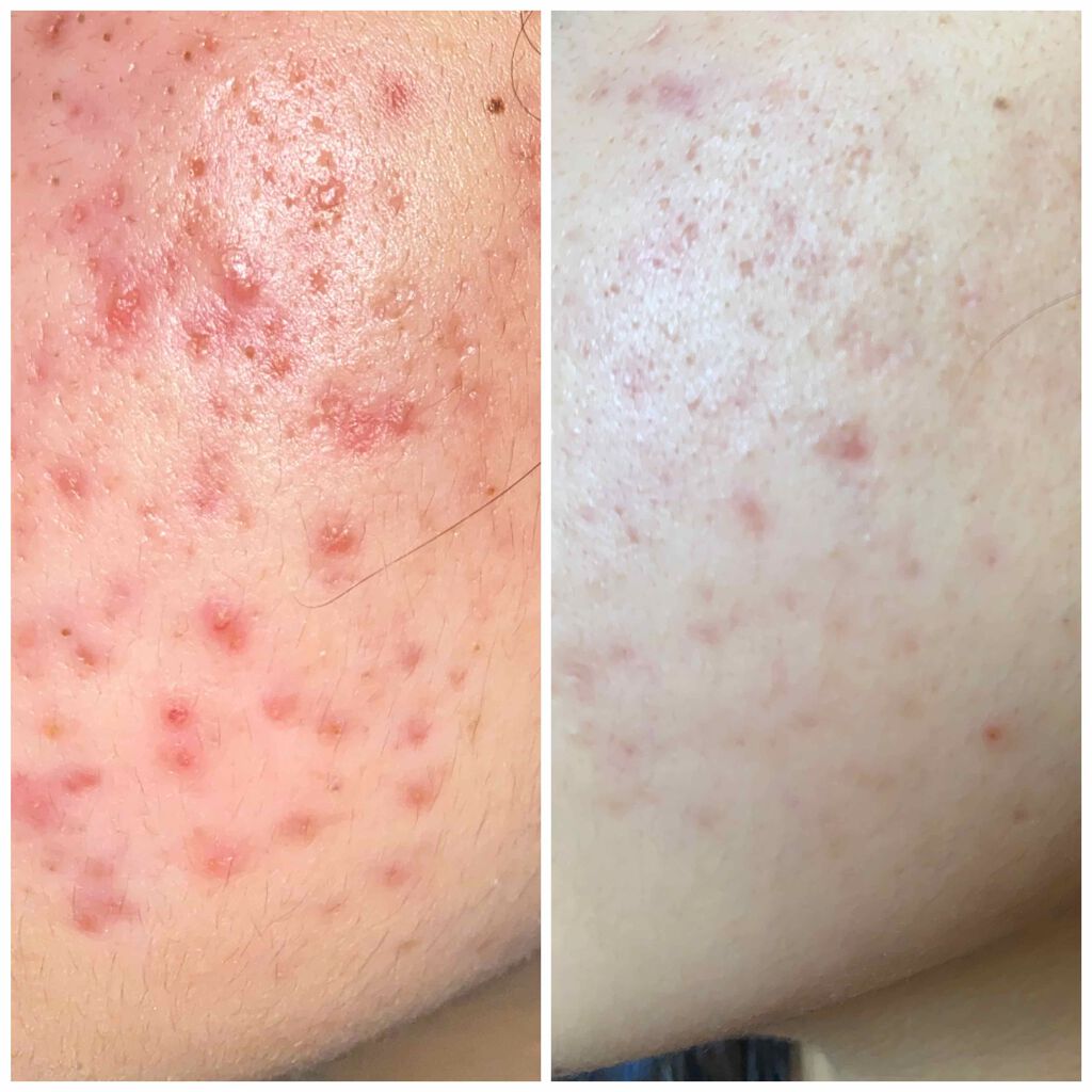 キールズ DS クリアリーブライト エッセンス[医薬部外品]/Kiehl's/美容液を使ったクチコミ（1枚目）