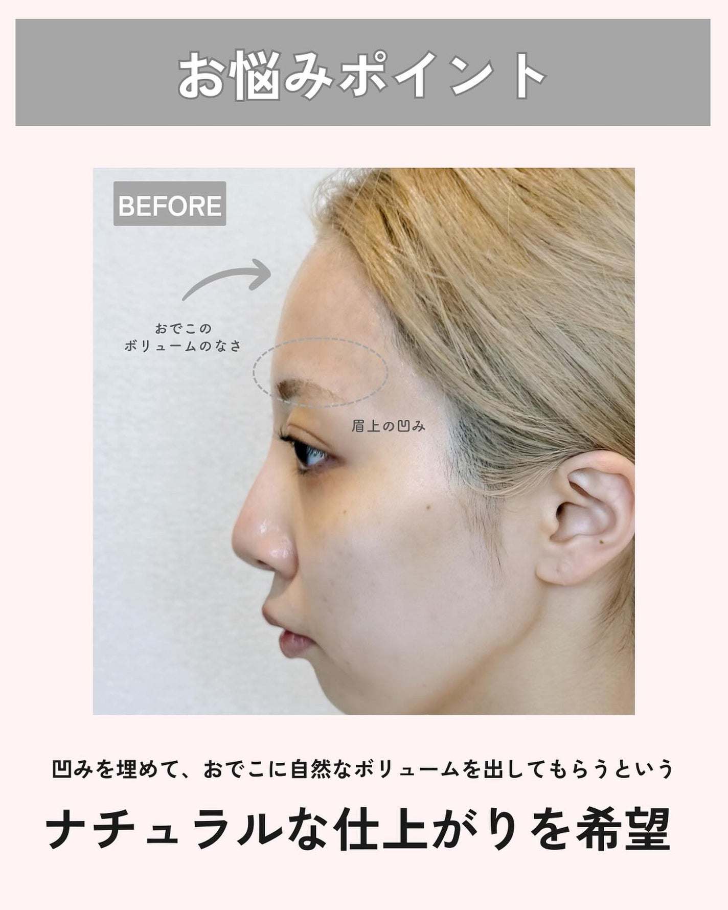 えむちゃん|3度のメシよりスキンケア on LIPS 「【おでこにヒアルロン酸入れてきた👼✨】ずっと入れたかったおでこ..」(2枚目)