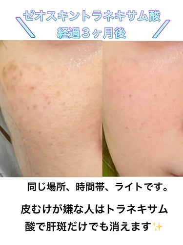 ややフォロバ100 on LIPS 「トラネキサム酸、ゼオスキン3ヶ月レビューしてみました✨トラネキ..」（2枚目）