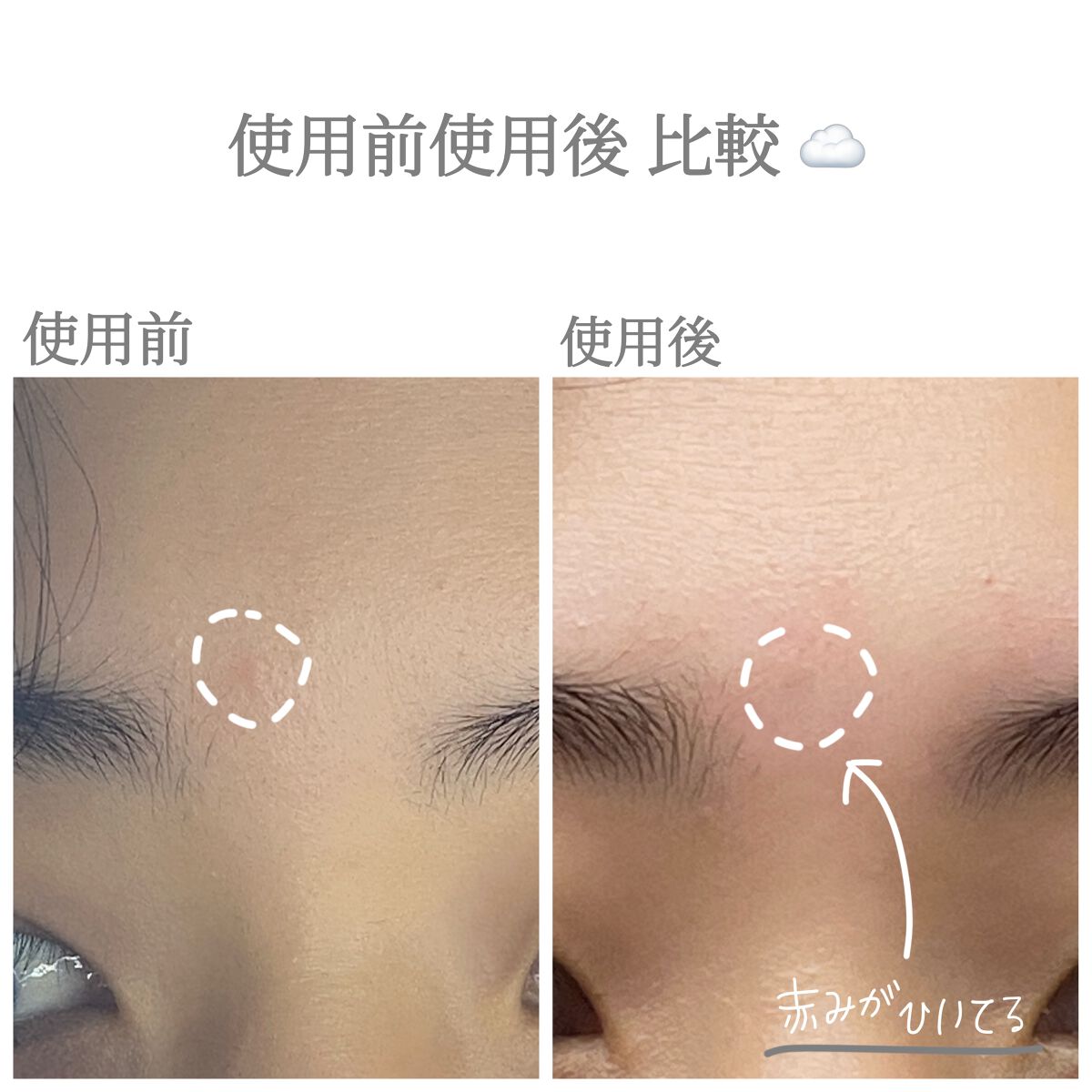 シカアロエスポットキット/FlEEF/にきびパッチを使ったクチコミ(5枚目)