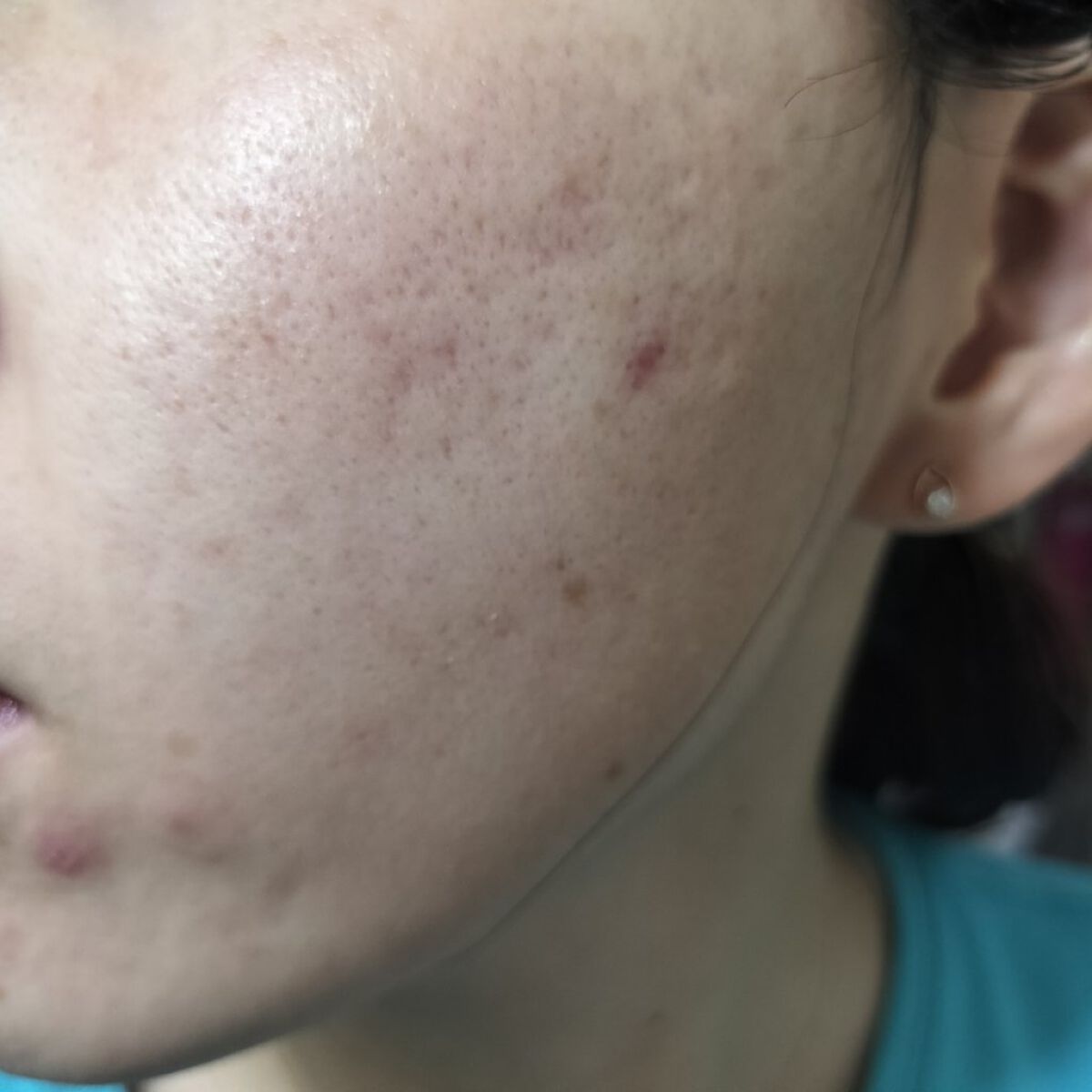 Amino Acid+B5/The Ordinary/美容液を使ったクチコミ（2枚目）