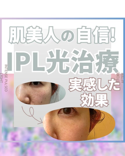 ããªã¬UV ã¢ã¯ã¢ãªãã ã¢ã¯ã¢ãããã¯ãããŒã·ã§ã³(æ°Žå±€ããã¯)/ããªã¬/æ¥çŒãæ¢ãããŒã·ã§ã³ã䜿ã£ãã¯ãã³ãïŒ1æç®ïŒ