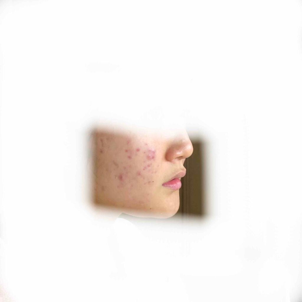 shiny_perfume_cr1 on LIPS 「初投稿失礼します!こういうほっぺに沢山できたニキビ(ニキビ跡)..」(1枚目)