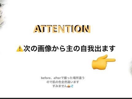セノ on LIPS 「ほくろ取りして3ヶ月経ちましたので経過報告です!日焼けに注意し..」(2枚目)