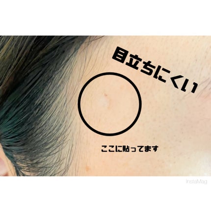 極薄透明パッチ nikipa!/金冠堂/にきびパッチを使ったクチコミ(7枚目)