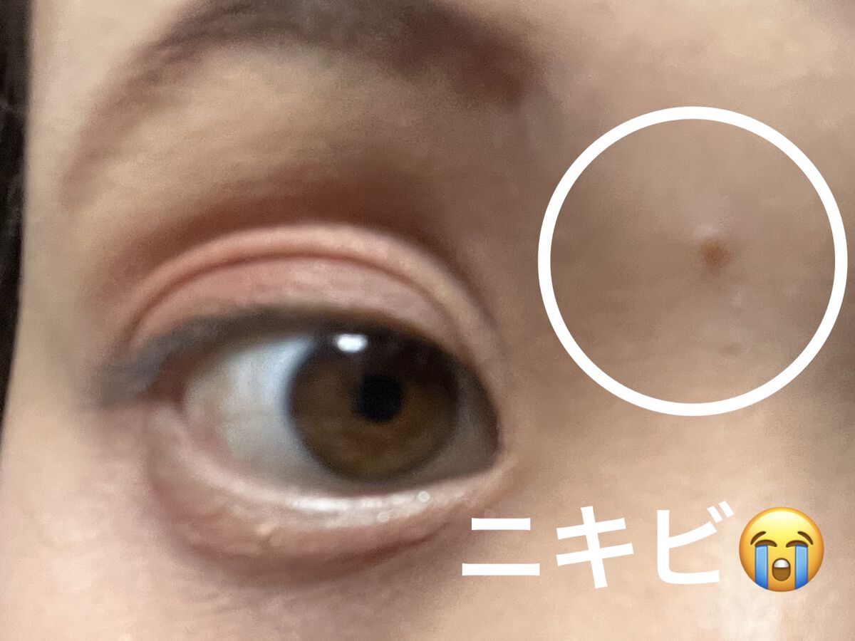 ニキビ治療薬(医薬品)/メンソレータム アクネス/その他を使ったクチコミ（3枚目）