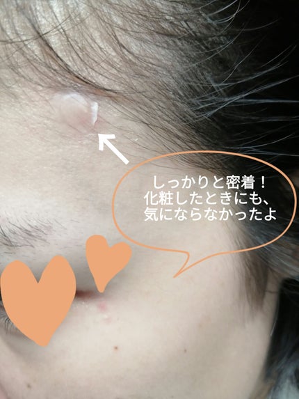 ゼロスポットパッチ/Today’s Cosme/にきびパッチを使ったクチコミ(3枚目)